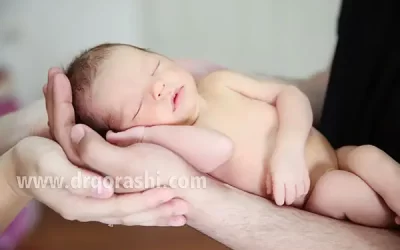 زردی در نوزاد